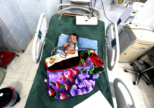 A Yemeni malnourished child receives medical treatment amid increasing threats of health collapse in war-torn Yemen in January, 2018 in Sana'a, Yemen. (Getty)