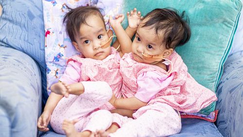 Conjoined twins Nima and Dawa remain close despite their surgical separation.