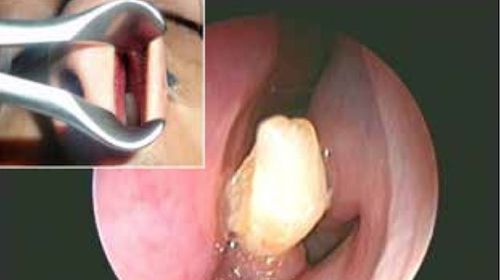 Rogue tooth cause of man's nosebleeds