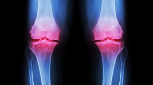 There are approximately three million sufferers of osteoarthritis in Australia. 