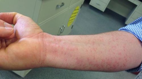 Kerry Sanders' mosquito-bitten arm. (Twitter)