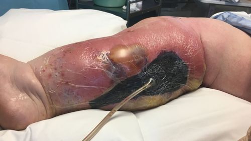 Mrs Hewat's wound after surgery with a vacuum dressing to promote healing. (Photo: Liz Hewat)