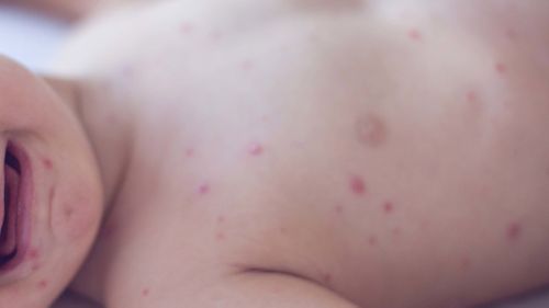 Health bosses are warning people in Sydney's west to be alert for symptoms of measles after a baby was ﻿diagnosed.