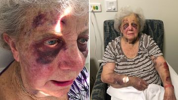 She suffered two black eyes and was covered in bruises.