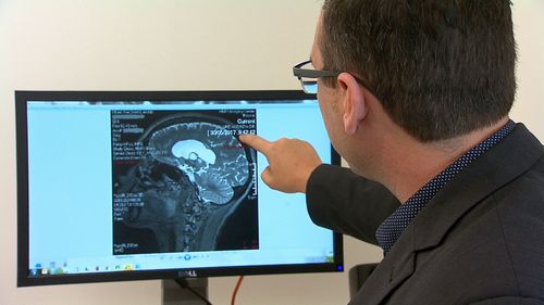 Newcastle researchers have shown that a synthetic form of human growth hormones helped mice repair their cognitive function after a stroke. Picture: 9NEWS