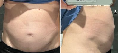 Georgie Beck's stomach was bloated before her diagnosis - these photos were taken after it was drained of fluid.