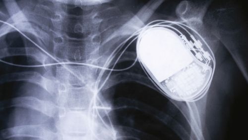 The new iPhone 12 has been shown to interfere with pacemakers and defibrillators.  