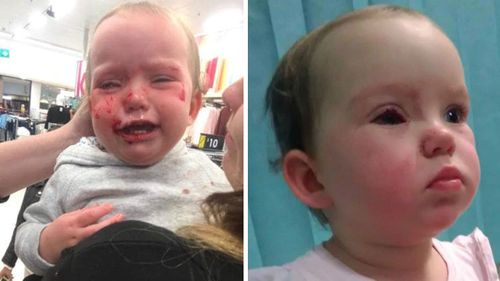 Hayley Skye Smith's daughter Amaia also injured her eye on the metal prong of a clothes rack.