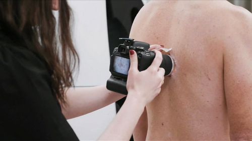 Report reveals impact of melanoma on Australians by 2030