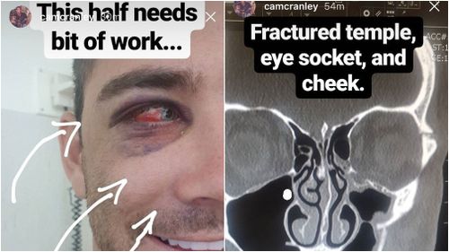 Mr Cranley captured the extent of his injuries in a series of Instagram "Stories". (Instagram)