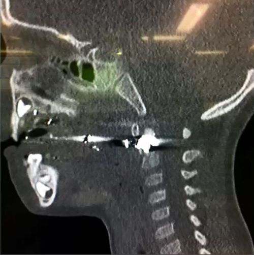 The bullet lodged in Cameron's spine, a millimetre away from doing irreversible damage.