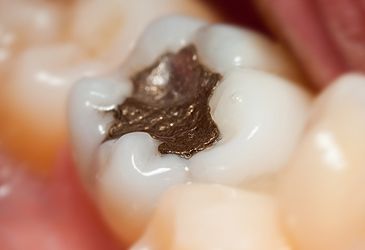 Amalgam is alloy of a number of different metals in combination with which element?