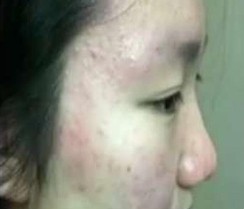 A Changzhou Foreign Languages School student suffering from rashes.