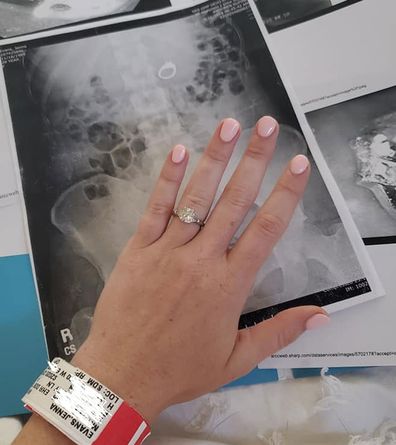 Woman swallows engagement ring in her sleep, needs surgery