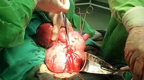 Dr Scladan led a team of surgeons to remove the tumour. (Supplied)