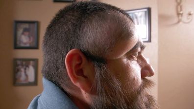 Dr. Pimple Popper - José, man with baseball-sized cyst