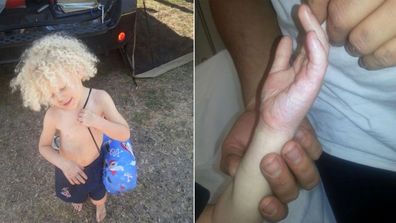 Kai suffered a severe burn on his hand while on a family camping trip