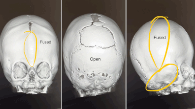 Surgeons will remove and then reconstruct a large part of Daisy's skull so her brain can keep growing