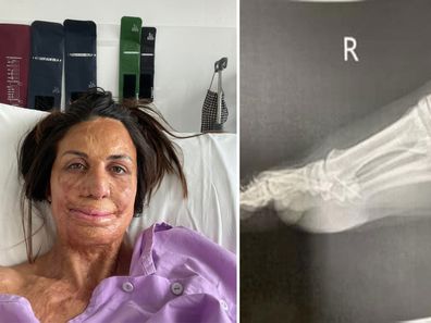 Turia Pitt has opened up about a painful injury after she stepped on a sewing needle and it became embedded in her foot