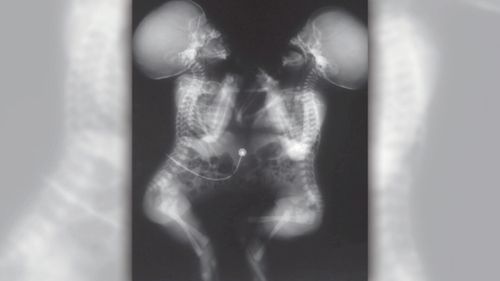 An X-ray of the twins, who are currently undergoing surgery at Melbourne's Royal Children's Hospital.
