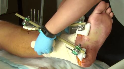 The Coburg local's leg was broken in three places. (9NEWS)