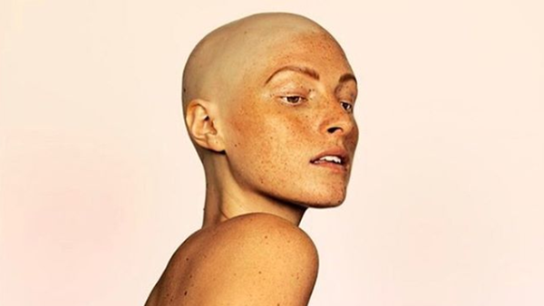 Model Amber Jean Rowan's entire head of hair fell out in a year