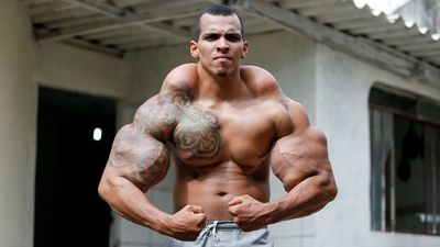 <strong>6. Synthol Injections</strong>
