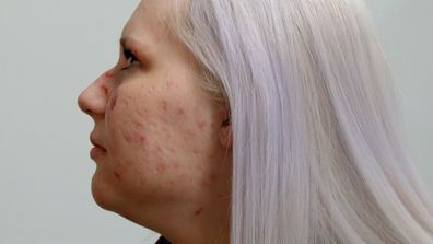 Hannah has severe skin condition on Embarrassing Bodies on 9Now