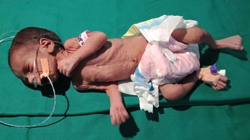The baby weighed just 1.1kg when it was discovered.