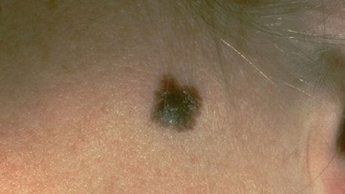 Groundbreaking research could see the prevention of skin cancer spreading in stage three patients. (AAP)