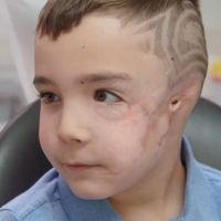 Heartwarming moment boy sees his new prosthetic ears after losing both in a dog attack