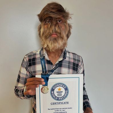 Lalit Patidar, 18, has the rare condition hypertrichosis, which has helped him set a Guinness World Record.