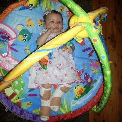 From a young age, Mia-Rose had to have her legs and feet bandaged to prevent further swelling.