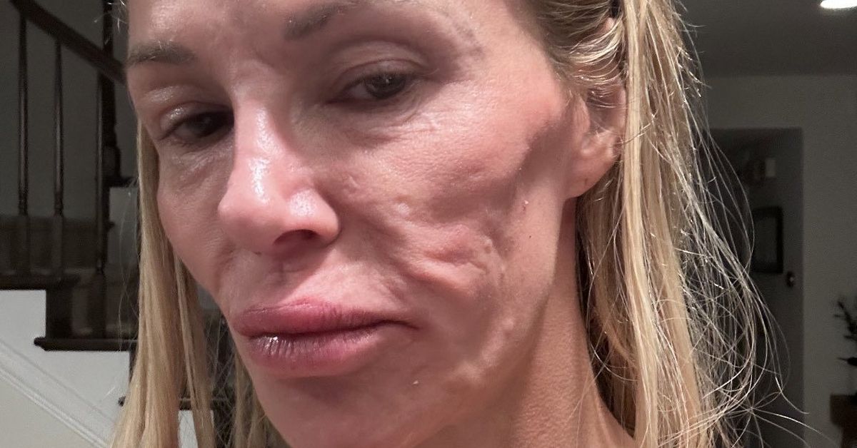 Brandi Glanville health update: Everything you need to know about Brandi Glanville’s ongoing health battle | Explainer