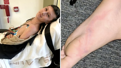 The bolt left fern-like marks on Talyn Rose's body.