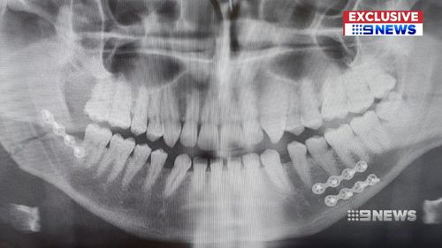 The victim required three titanium plates in his jaw.