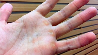 Calluses forming on palms from gripping gym equipment, how can i prevent  this? : r/strength_training