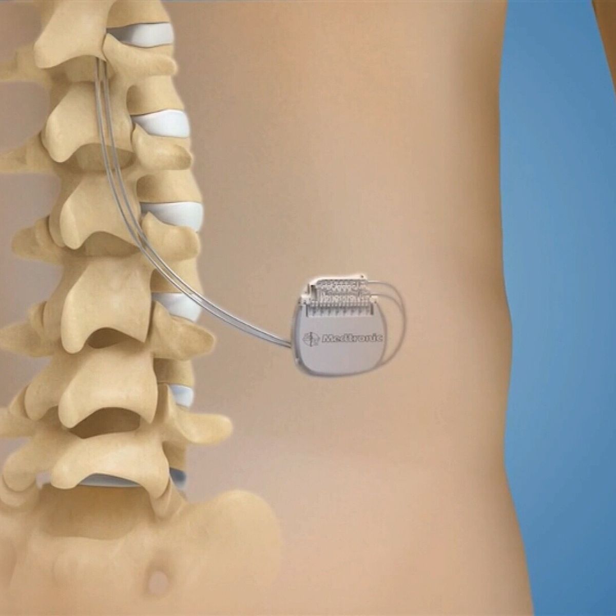 Chronic back pain now being treated with world's smallest battery