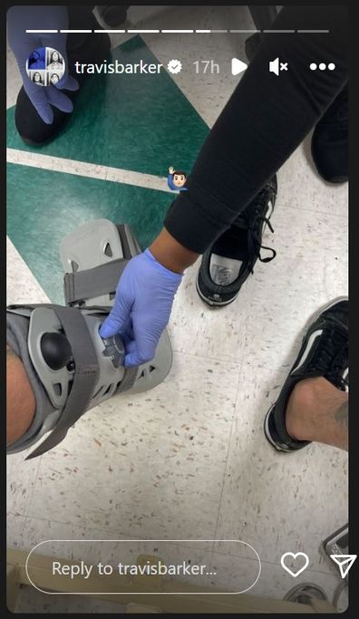 Travis Barker revela que quebrou o dedo do pé por alguns dias.