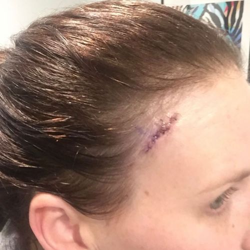 História de câncer de pele: Sara, mulher de Melbourne