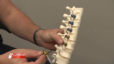 Aussies could miss out on back pain treatment