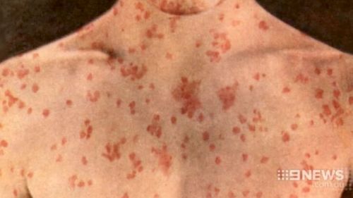 Measles patient confirmed in Brisbane