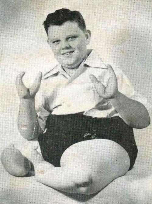 Grady Stiles appeared in circus 'freak shows' because of his abnormality.