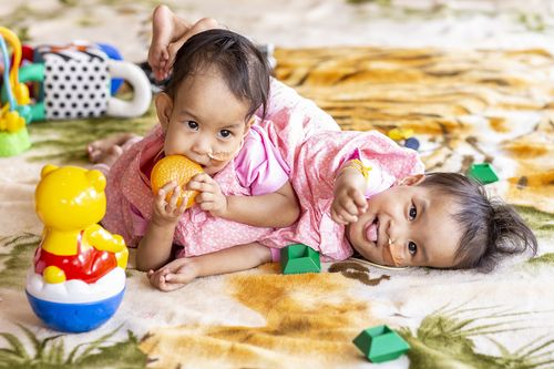 Conjoined twins Nima and Dawa are seen at Miracle sMiles Retreat in East Kilmore, Victoria.