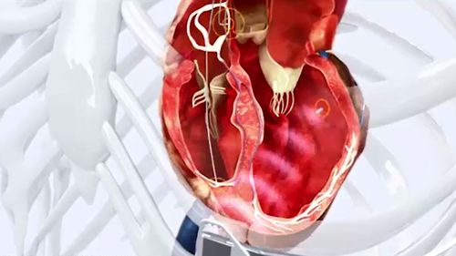 The technology uses an electrode placed inside the left ventricle of the heart.