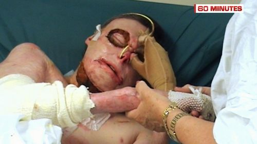 And he was left with life-changing injuries, including deep burns to much of his body. (60 Minutes)