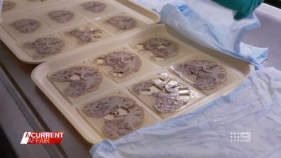 A landmark study looked at the results of 31 post-mortem brain examinations of former rugby league players and found CTE in 68 per cent of them.