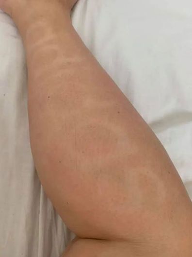 Woman fake tanned 'Adidas' into her leg during coronavirus lockdown.