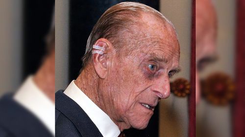 Prince Philip shows off a shiner, but where did he get it from?