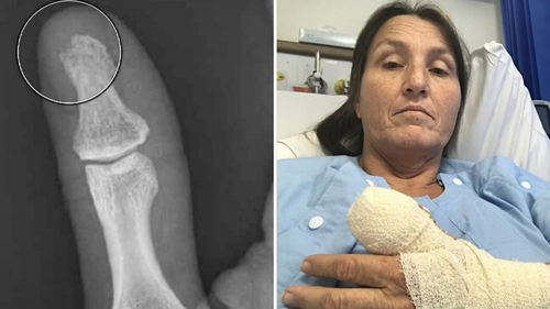 The 48-year-old claims she contracted bone-eating bacteria after getting a manicure at a Perth beauty salon.